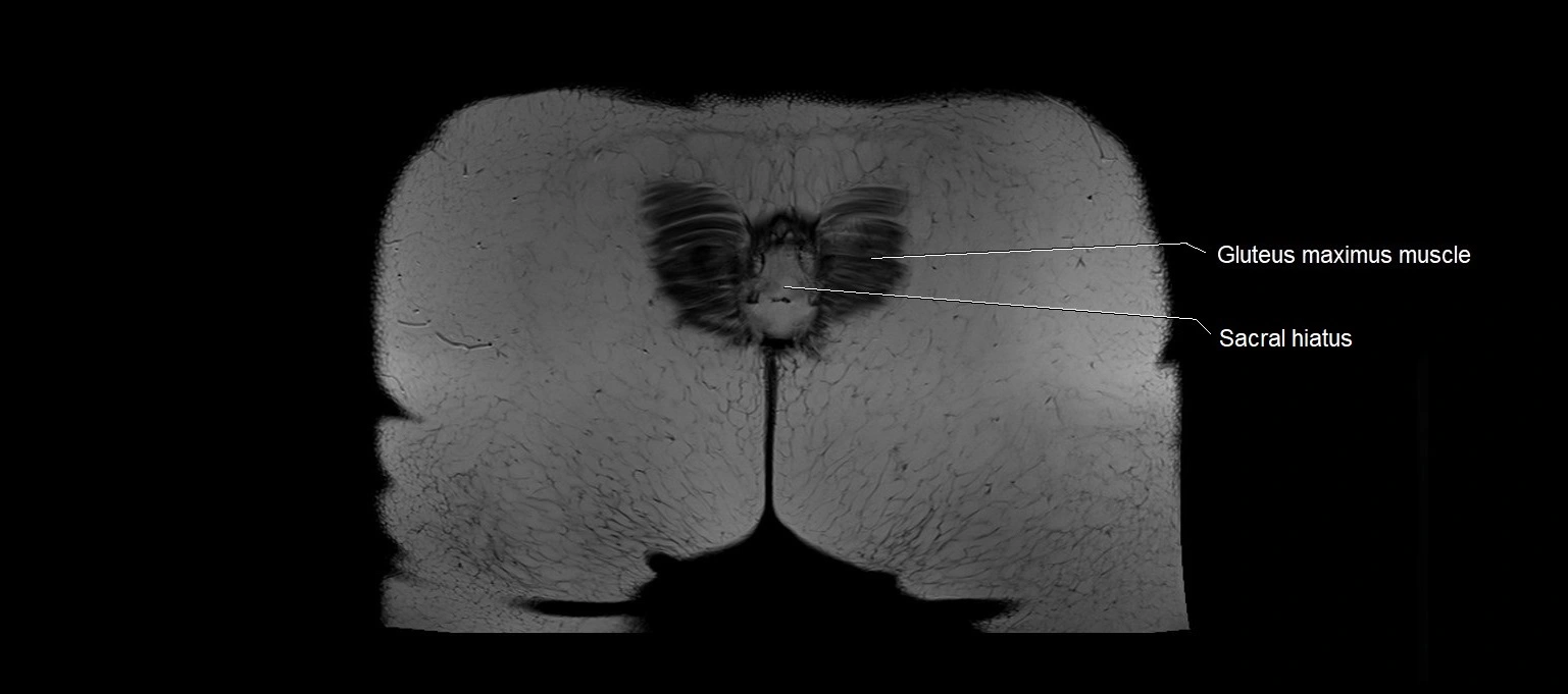 MRI 3T pelvis coronal cross section anatomy image 29.webp